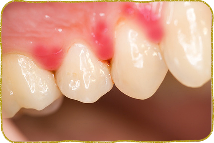 臭い 歯石 その口臭、歯石が原因かも！歯石除去のさまざまなメリットと予防法