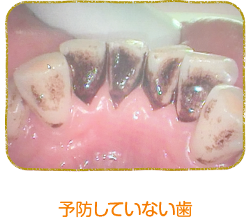 予防歯科 久喜市の歯科 歯医者なら からさわ歯科クリニック