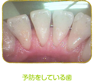予防歯科 久喜市の歯科 歯医者なら からさわ歯科クリニック